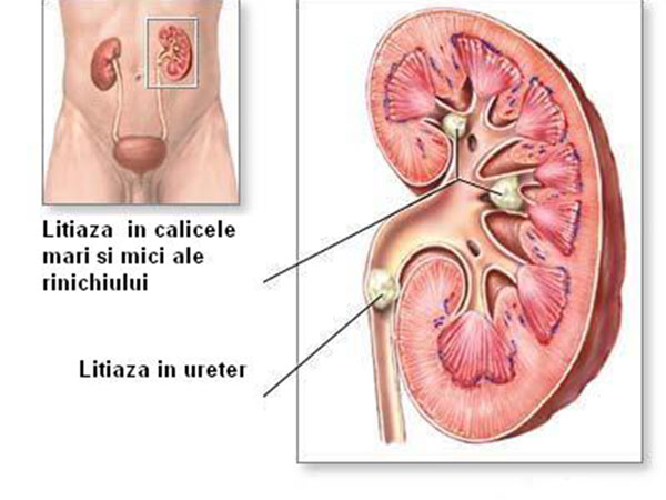 Litiaza urinara (pietrele)